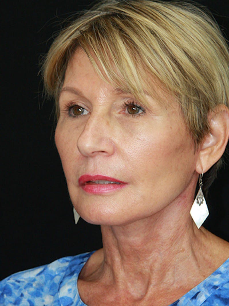 Facelift & Neck Lift Before & After Gallery - Patient 143521851 - Image 8