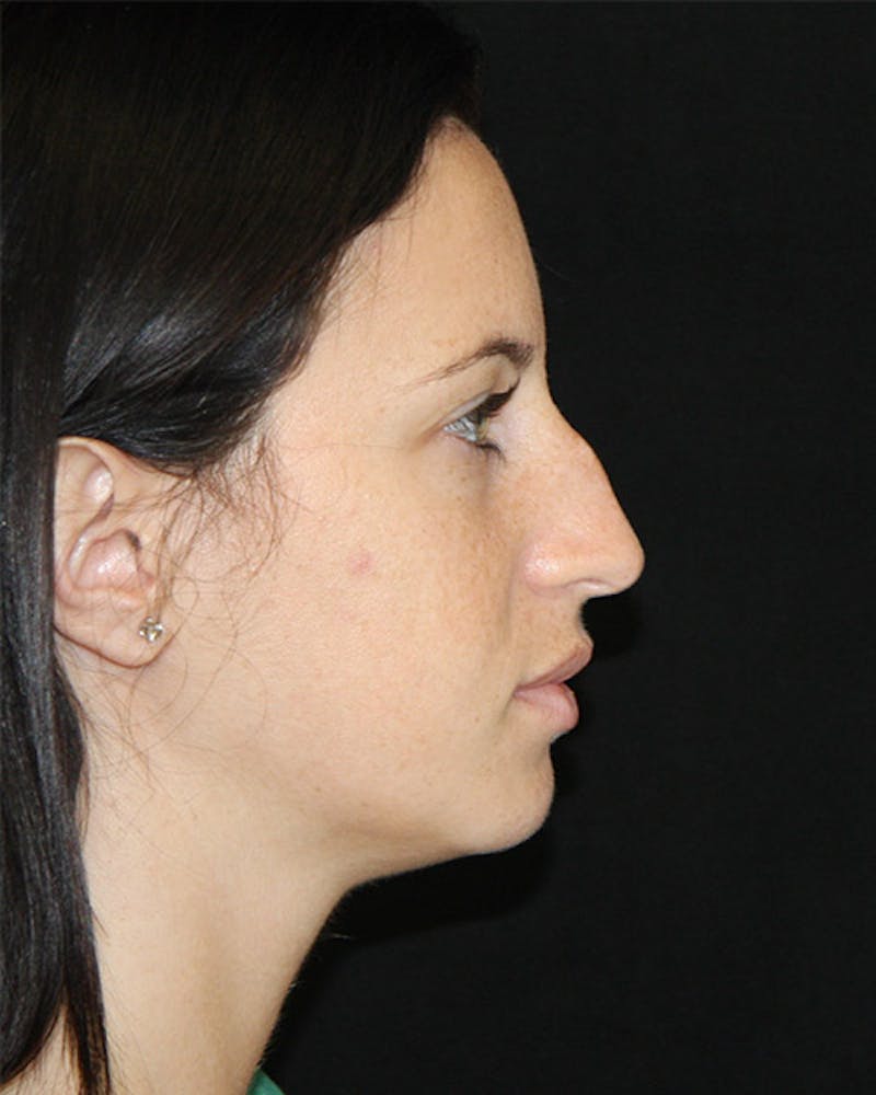 Rhinoplasty Before & After Gallery - Patient 143521854 - Image 5