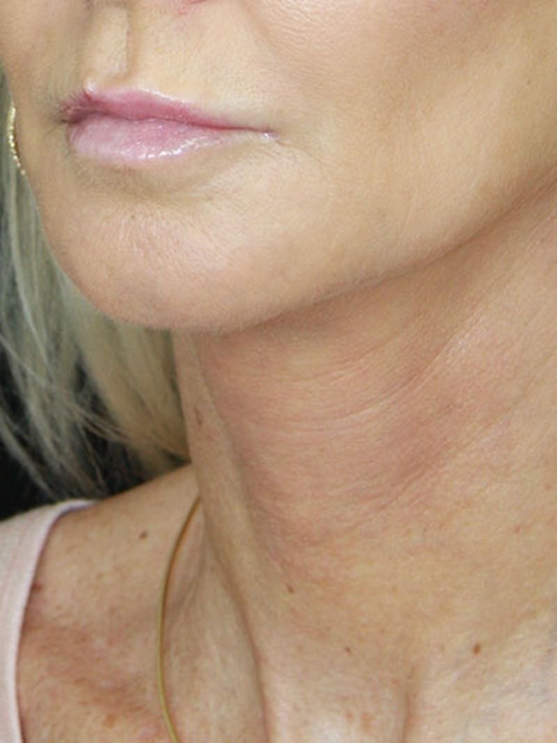 Facelift & Neck Lift Before & After Gallery - Patient 177546574 - Image 2