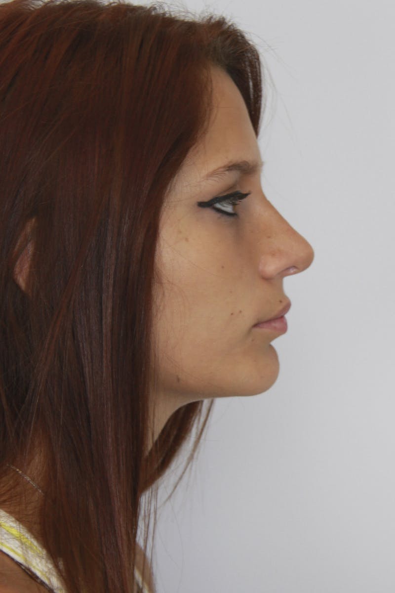 Chin Augmentation Before & After Gallery - Patient 143521865 - Image 4