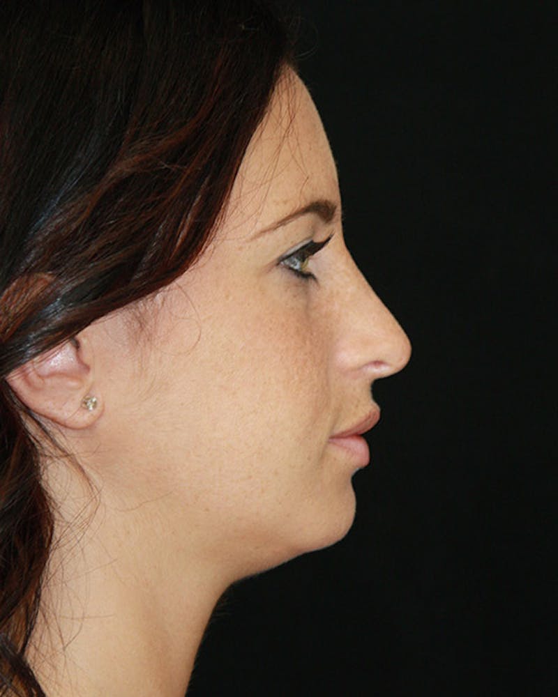 Rhinoplasty Before & After Gallery - Patient 143521854 - Image 6