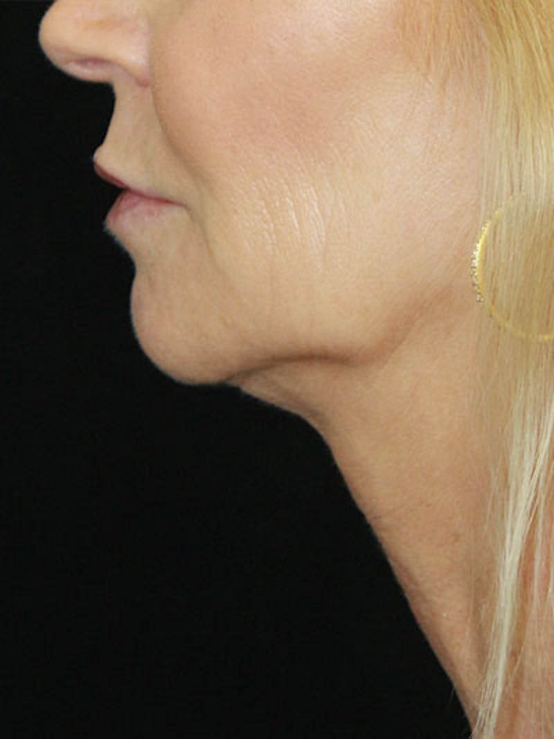 Facelift & Neck Lift Before & After Gallery - Patient 177546574 - Image 3