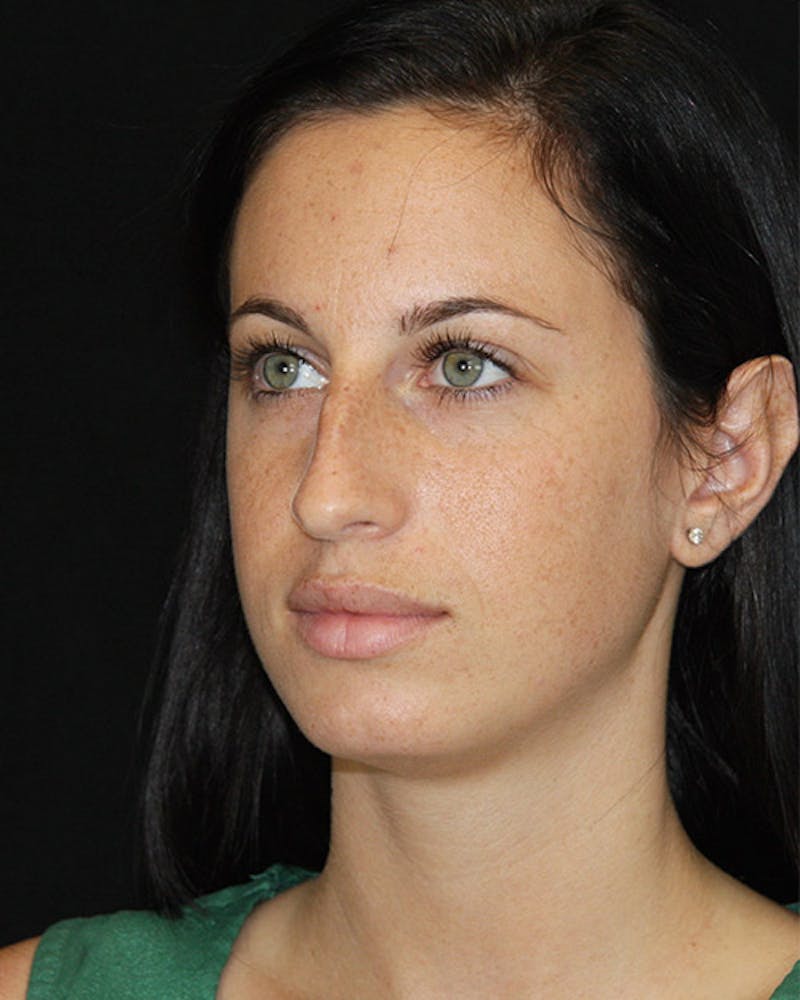 Rhinoplasty Before & After Gallery - Patient 143521854 - Image 7