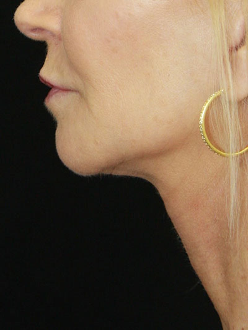Facelift & Neck Lift Before & After Gallery - Patient 177546574 - Image 4
