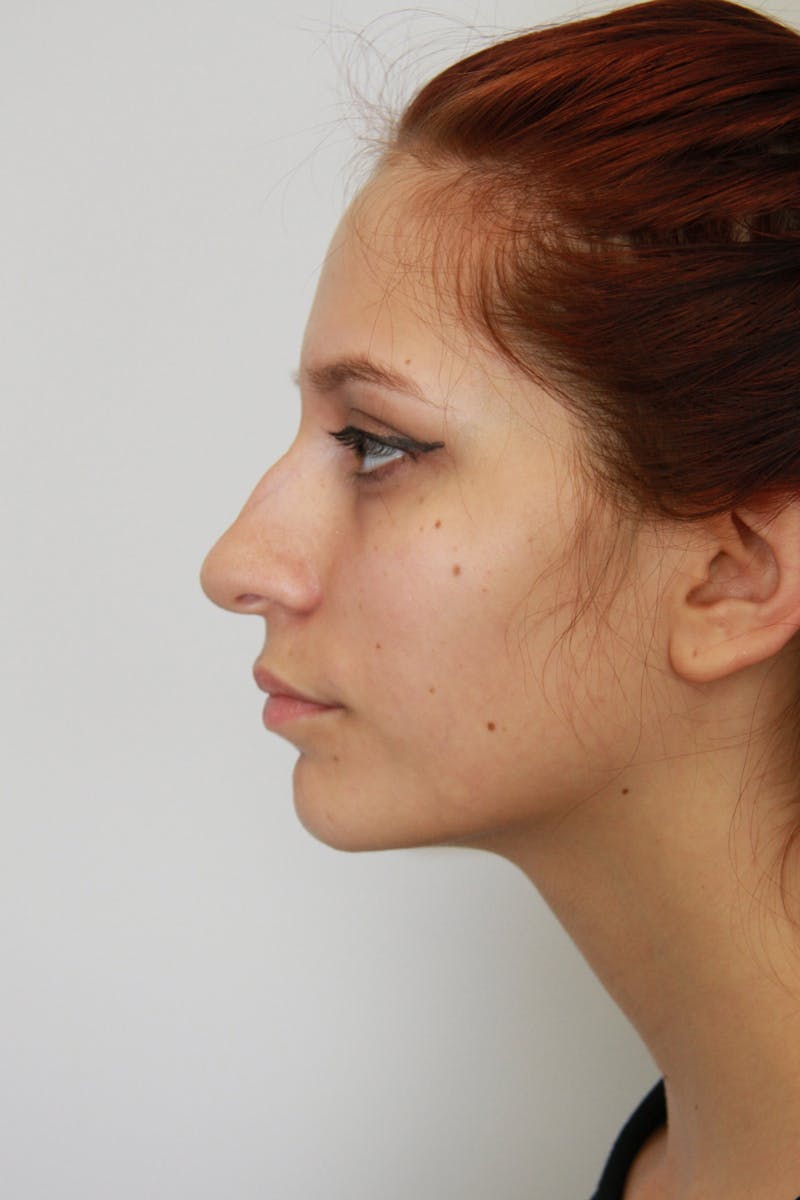 Chin Augmentation Before & After Gallery - Patient 143521865 - Image 5