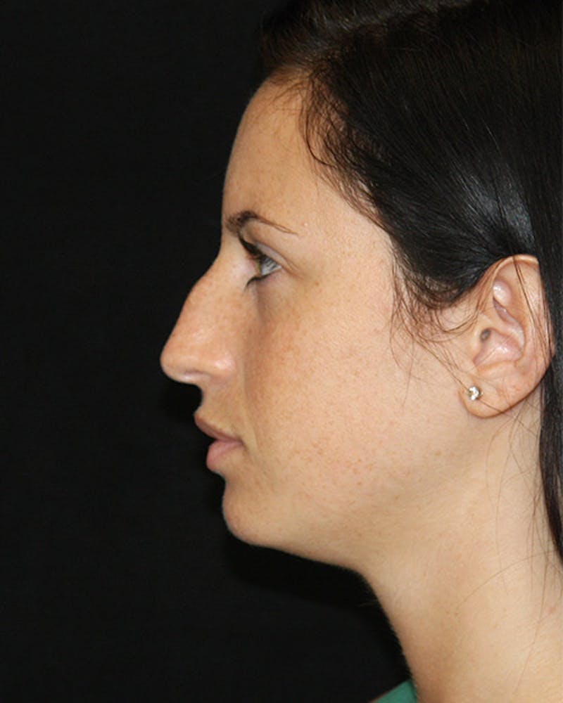 Rhinoplasty Before & After Gallery - Patient 143521854 - Image 9