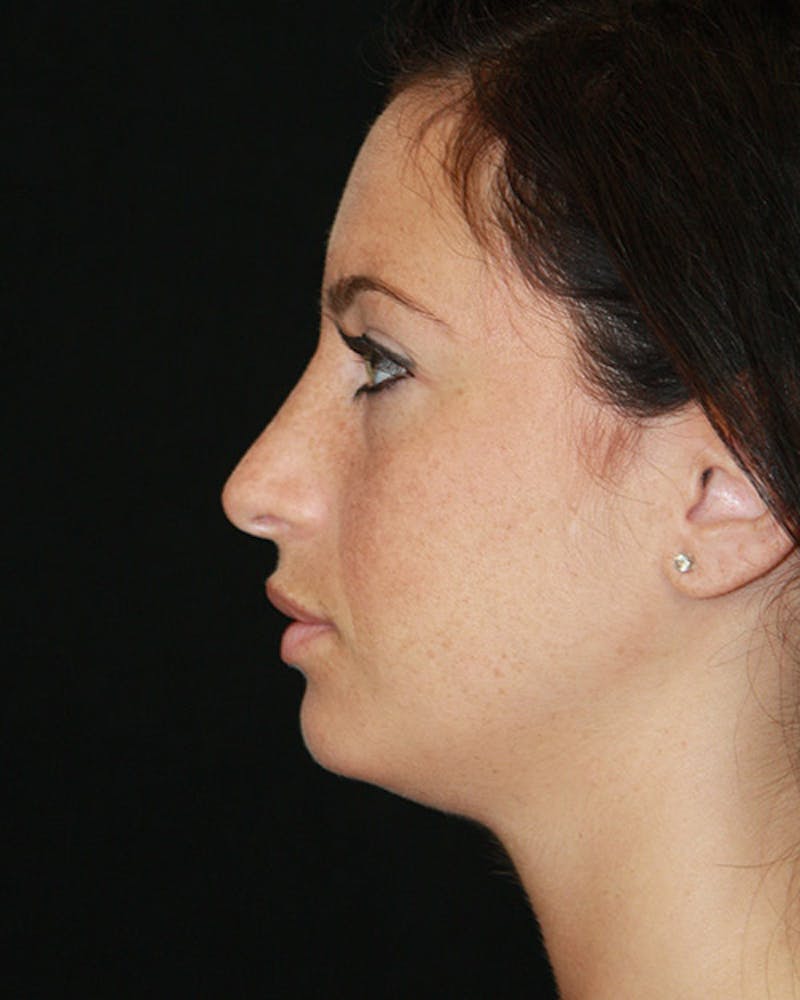 Rhinoplasty Before & After Gallery - Patient 143521854 - Image 10