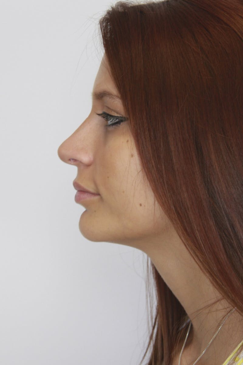 Chin Augmentation Before & After Gallery - Patient 143521865 - Image 6