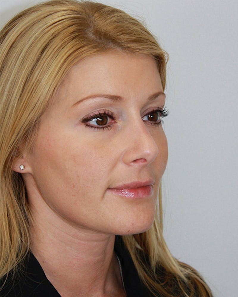 Rhinoplasty Before & After Gallery - Patient 143521868 - Image 2