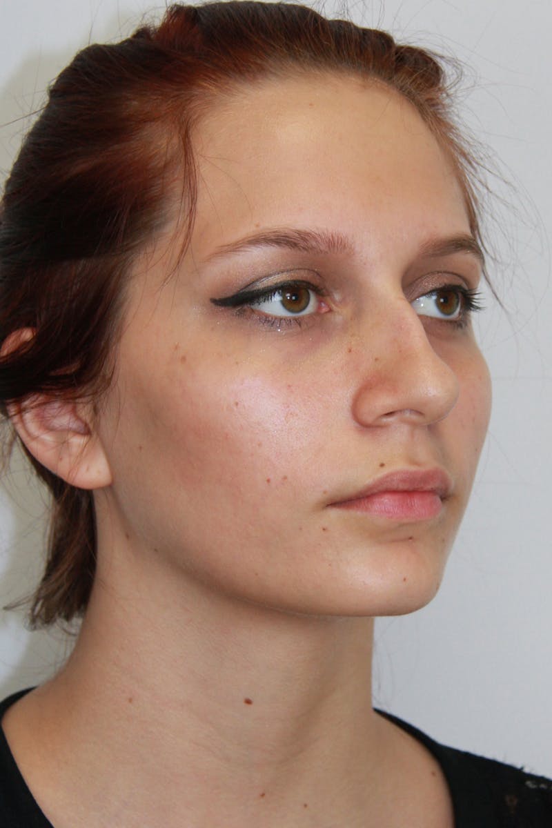 Chin Augmentation Before & After Gallery - Patient 143521865 - Image 7