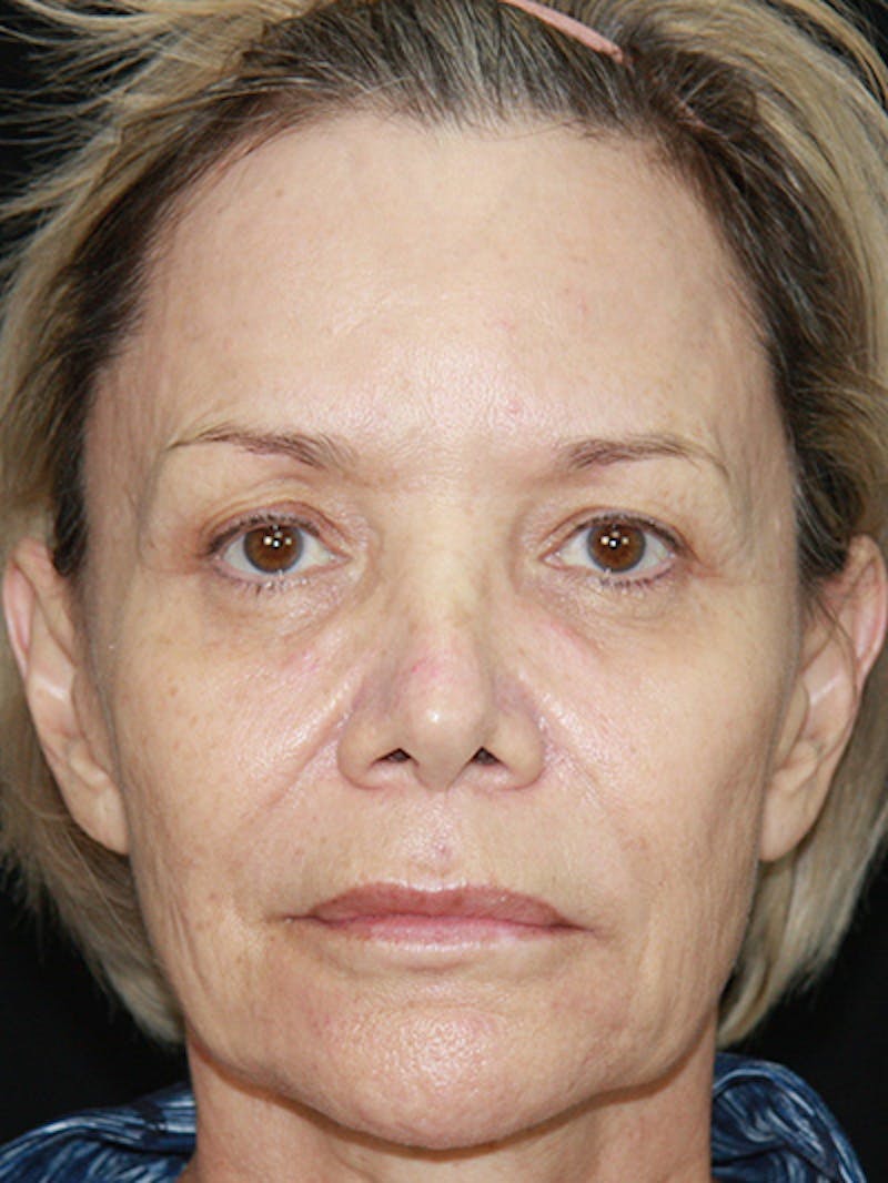 Facelift & Neck Lift Before & After Gallery - Patient 143521872 - Image 1