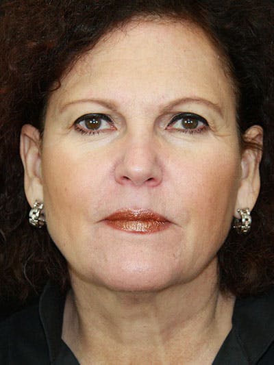 Brow Lift Before & After Gallery - Patient 143521859 - Image 1