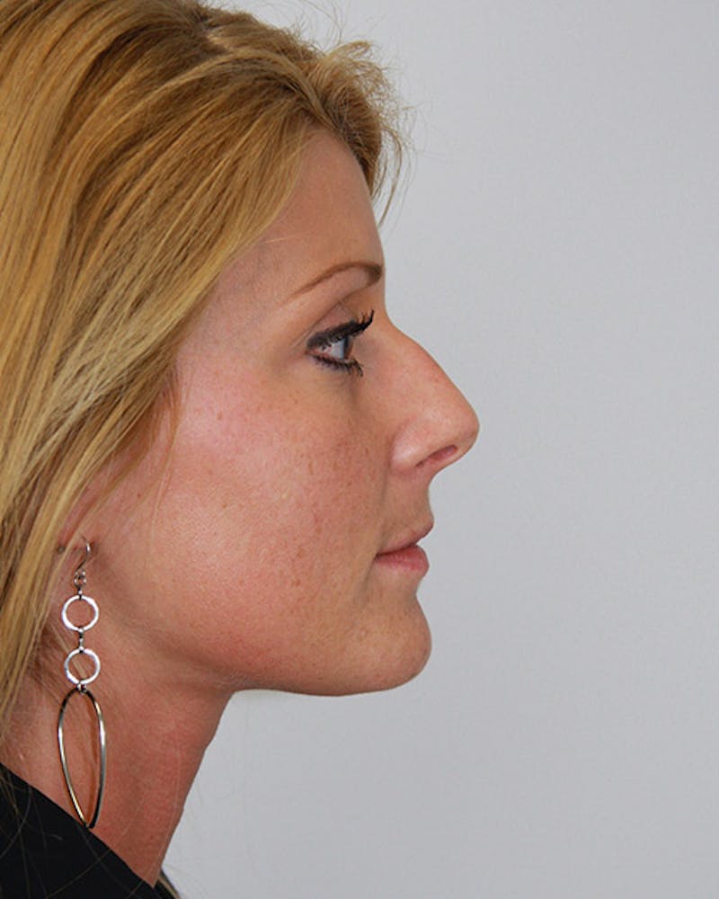 Rhinoplasty Before & After Gallery - Patient 143521868 - Image 3