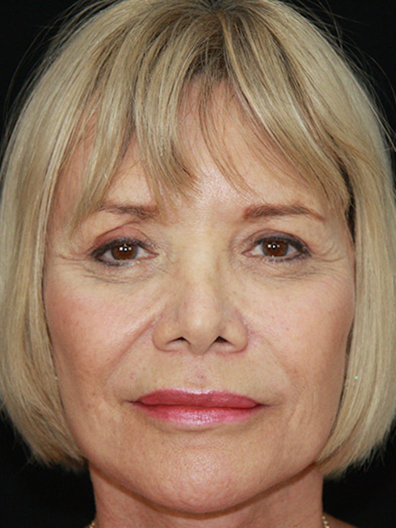 Facelift & Neck Lift Before & After Gallery - Patient 143521872 - Image 2