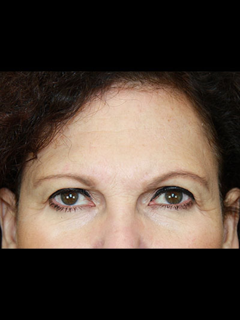 Brow Lift Before & After Gallery - Patient 143521859 - Image 3