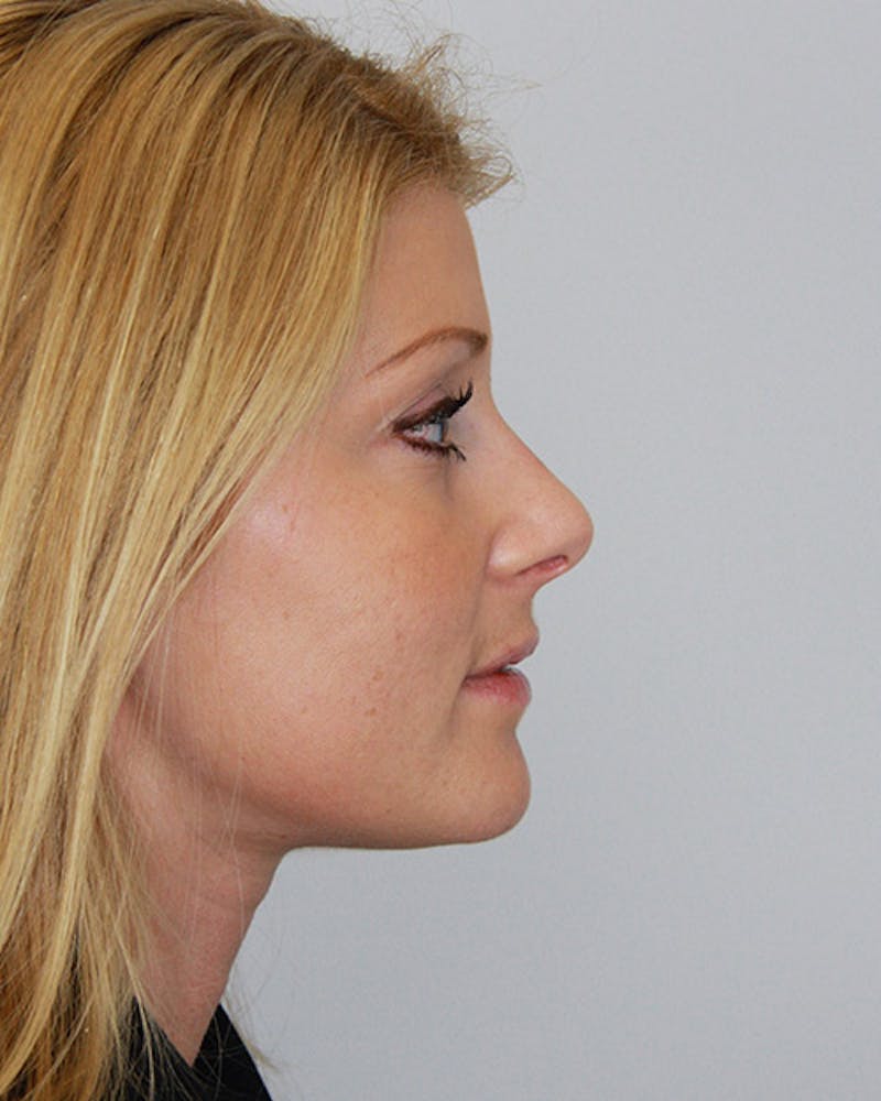 Rhinoplasty Before & After Gallery - Patient 143521868 - Image 4