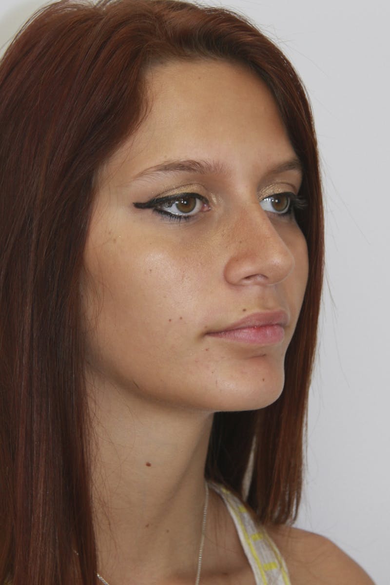 Chin Augmentation Before & After Gallery - Patient 143521865 - Image 8