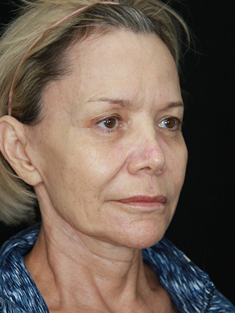 Facelift & Neck Lift Before & After Gallery - Patient 143521872 - Image 3