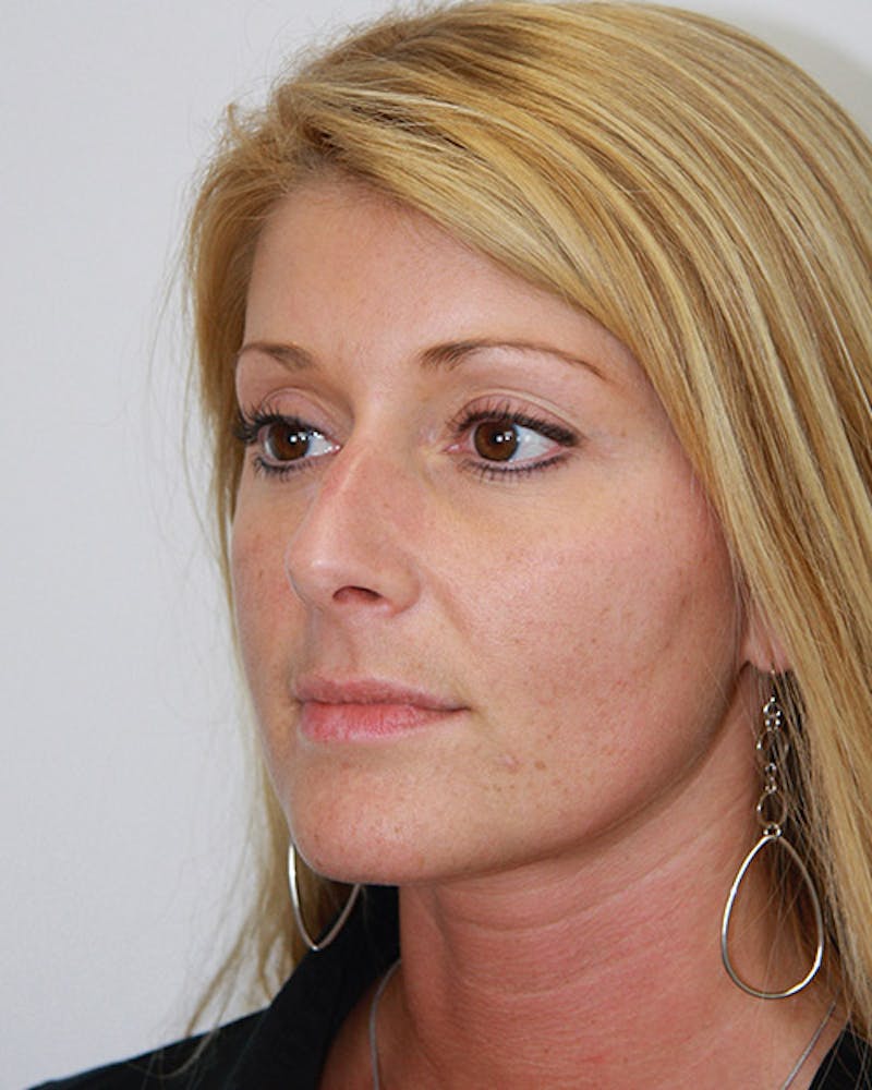 Rhinoplasty Before & After Gallery - Patient 143521868 - Image 5