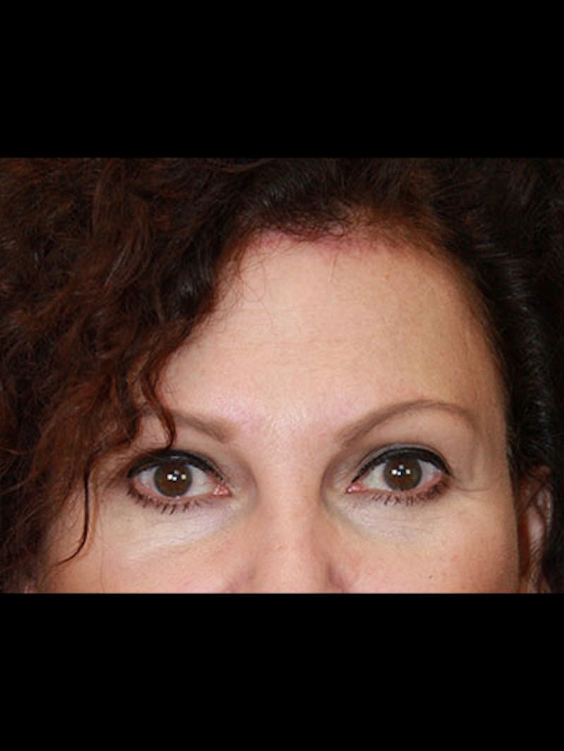 Brow Lift Before & After Gallery - Patient 143521859 - Image 4