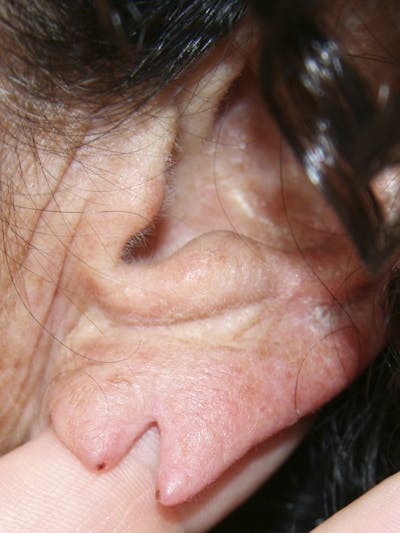 Ear Lobe Repair Before & After Gallery - Patient 143521867 - Image 1