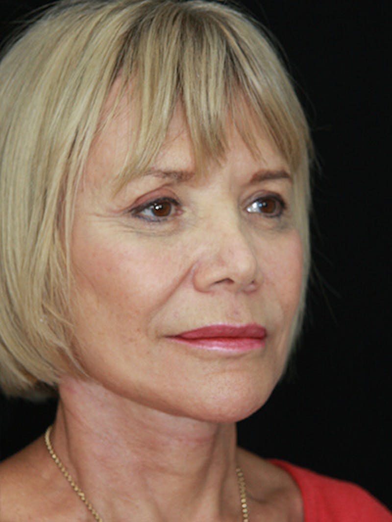 Facelift & Neck Lift Before & After Gallery - Patient 143521872 - Image 4