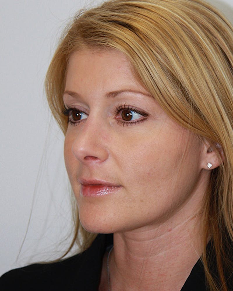 Rhinoplasty Before & After Gallery - Patient 143521868 - Image 6