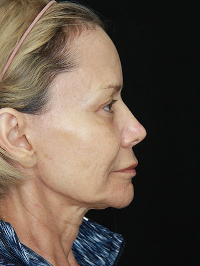 Facelift & Neck Lift Before & After Gallery - Patient 143521872 - Image 5