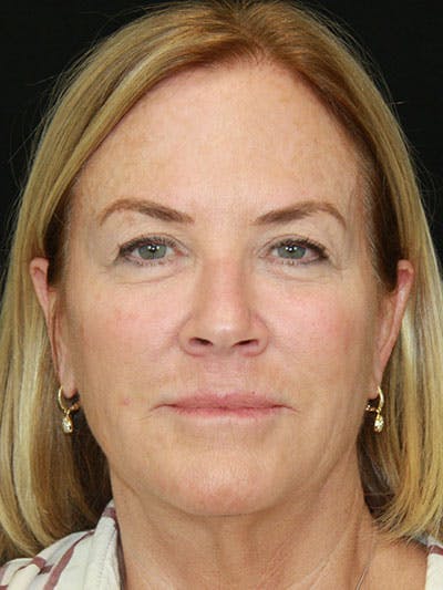 Brow Lift Before & After Gallery - Patient 143521869 - Image 1