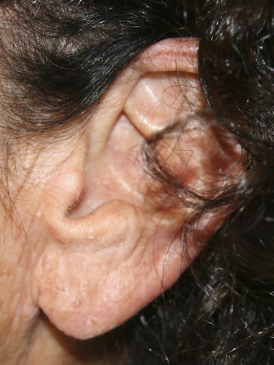 Ear Lobe Repair Before & After Gallery - Patient 143521867 - Image 2