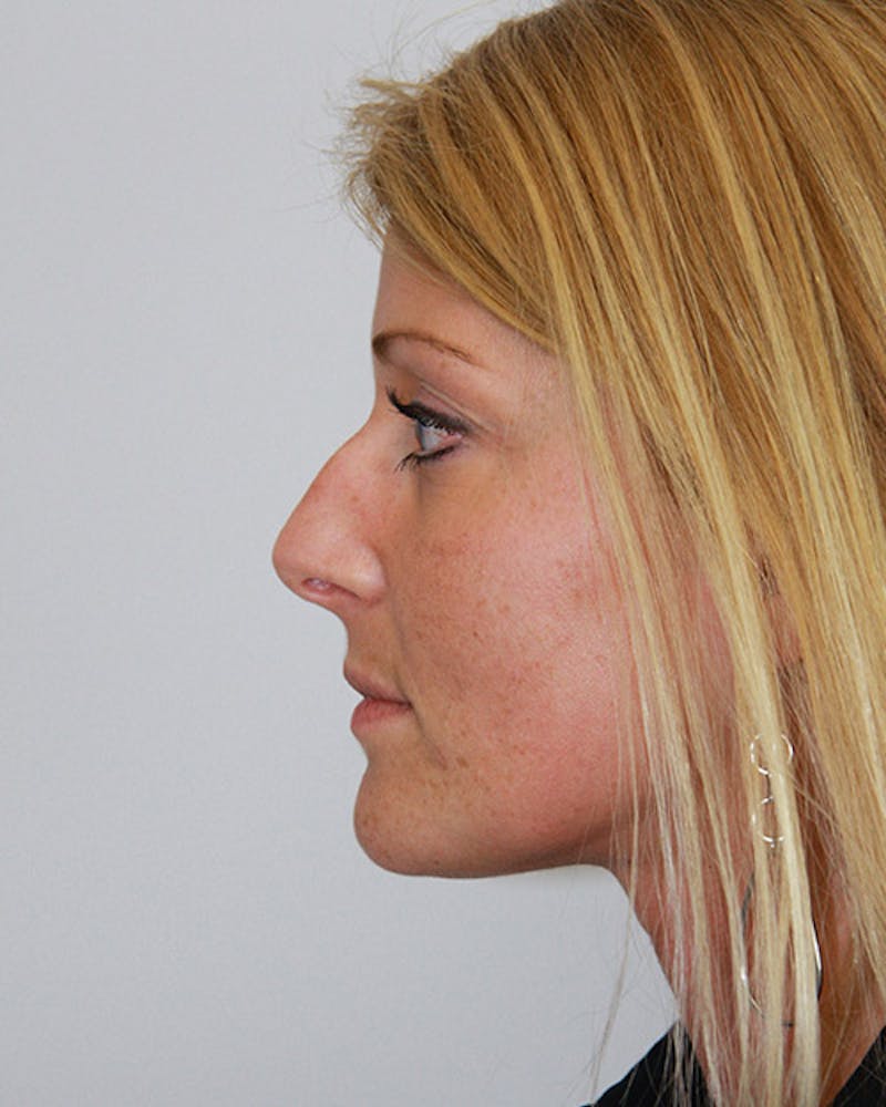 Rhinoplasty Before & After Gallery - Patient 143521868 - Image 7