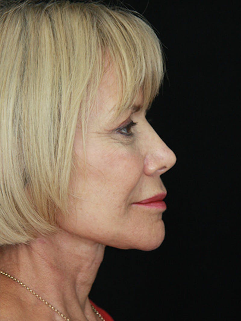 Facelift & Neck Lift Before & After Gallery - Patient 143521872 - Image 6
