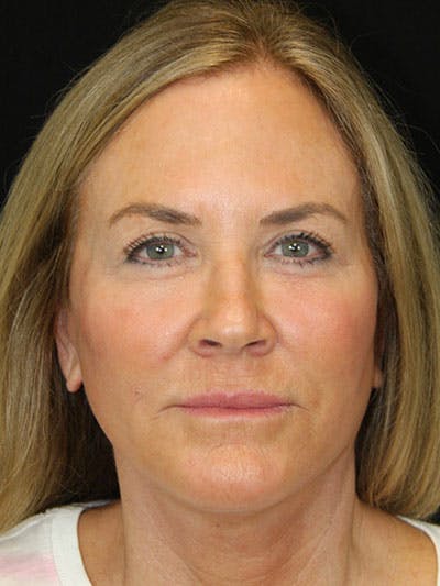 Brow Lift Before & After Gallery - Patient 143521869 - Image 2