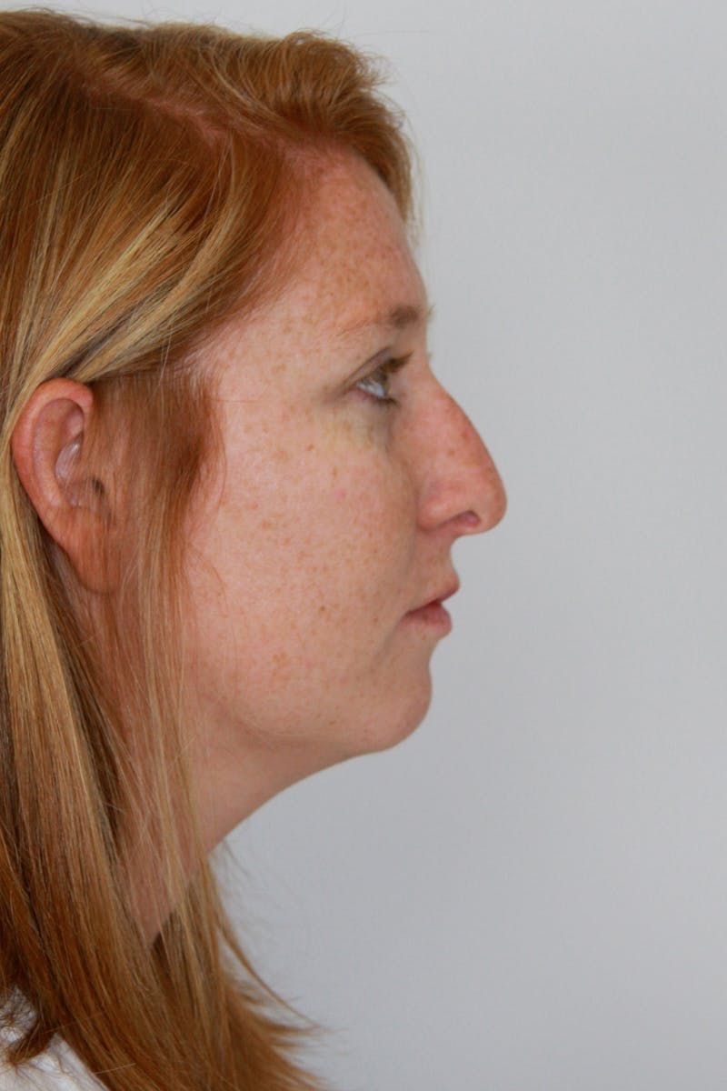 Chin Augmentation Before & After Gallery - Patient 143521889 - Image 1