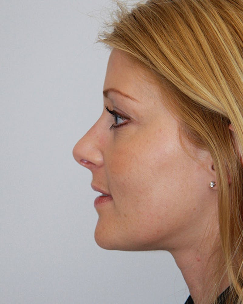 Rhinoplasty Before & After Gallery - Patient 143521868 - Image 8