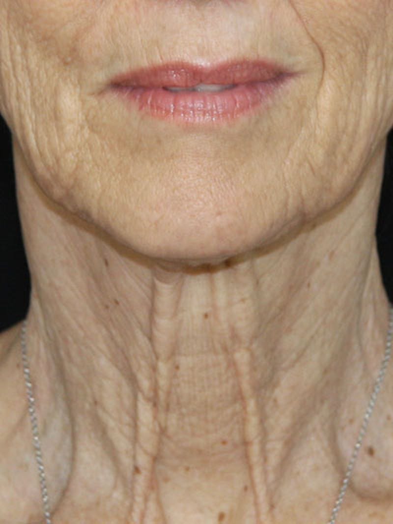 Facelift & Neck Lift Before & After Gallery - Patient 177555042 - Image 1