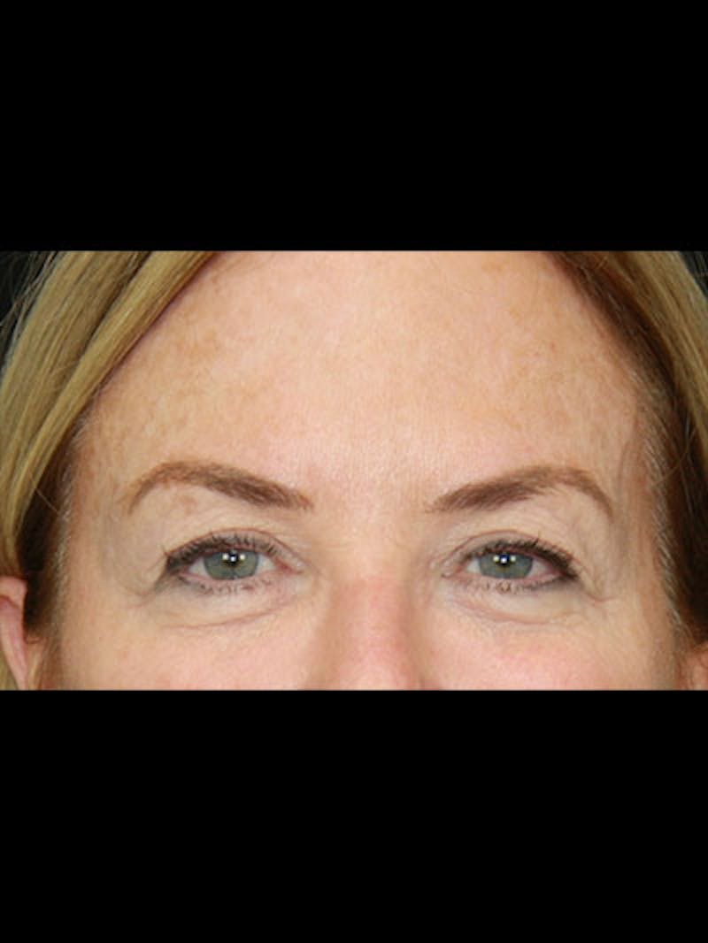 Brow Lift Before & After Gallery - Patient 143521869 - Image 3