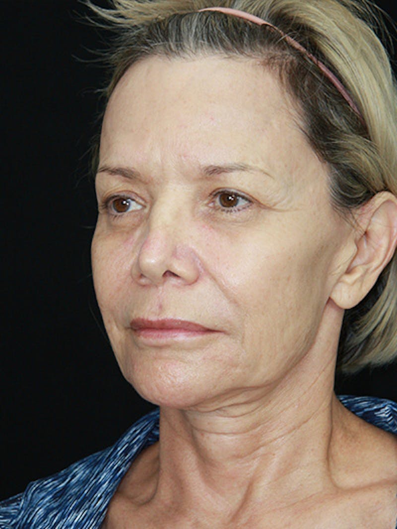 Facelift & Neck Lift Before & After Gallery - Patient 143521872 - Image 7