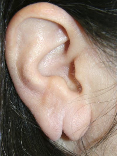 Ear Lobe Repair Before & After Gallery - Patient 143521871 - Image 1