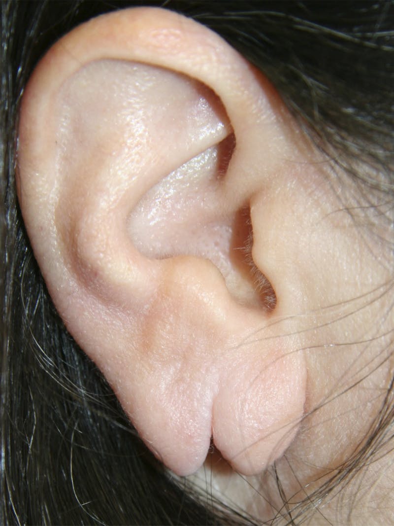 Ear Lobe Repair Before & After Gallery - Patient 143521871 - Image 1