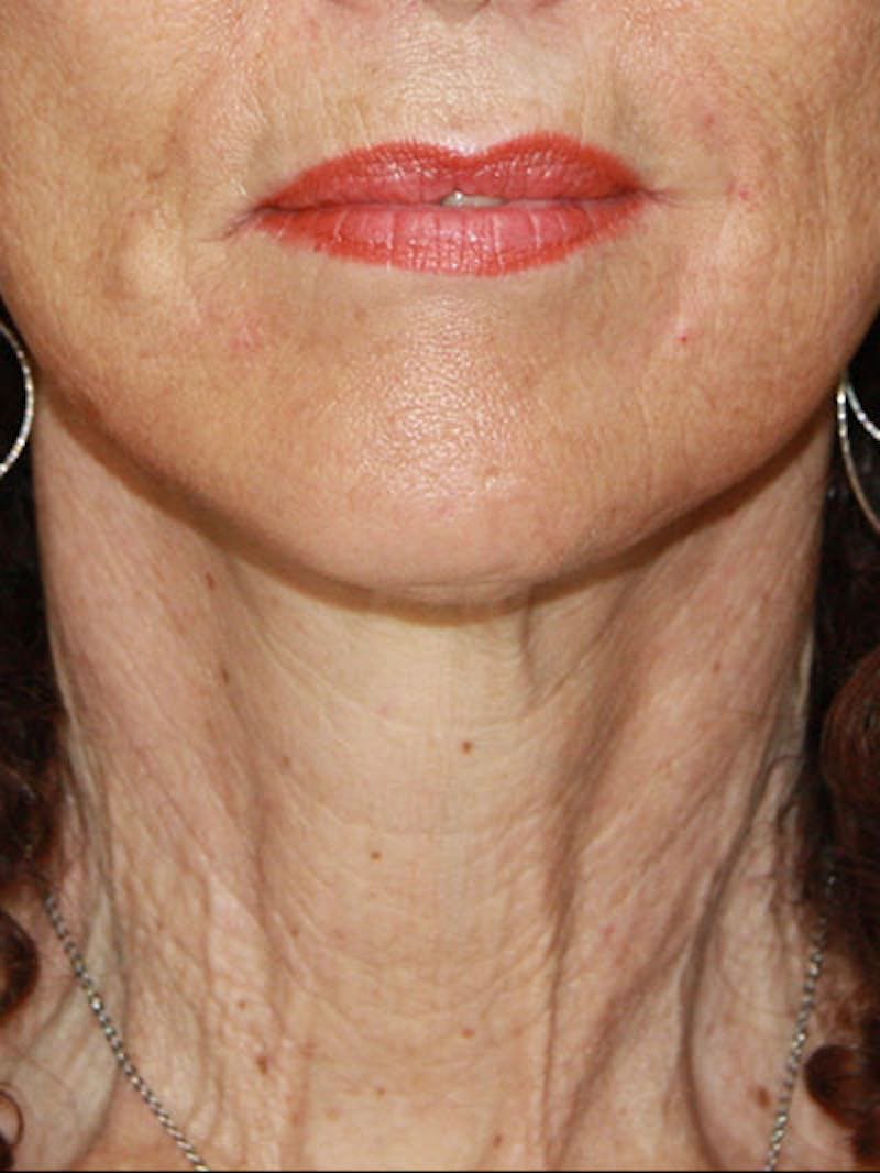 Facelift & Neck Lift Before & After Gallery - Patient 177555042 - Image 2