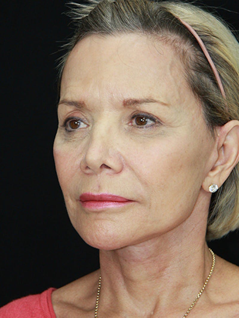 Facelift & Neck Lift Before & After Gallery - Patient 143521872 - Image 8