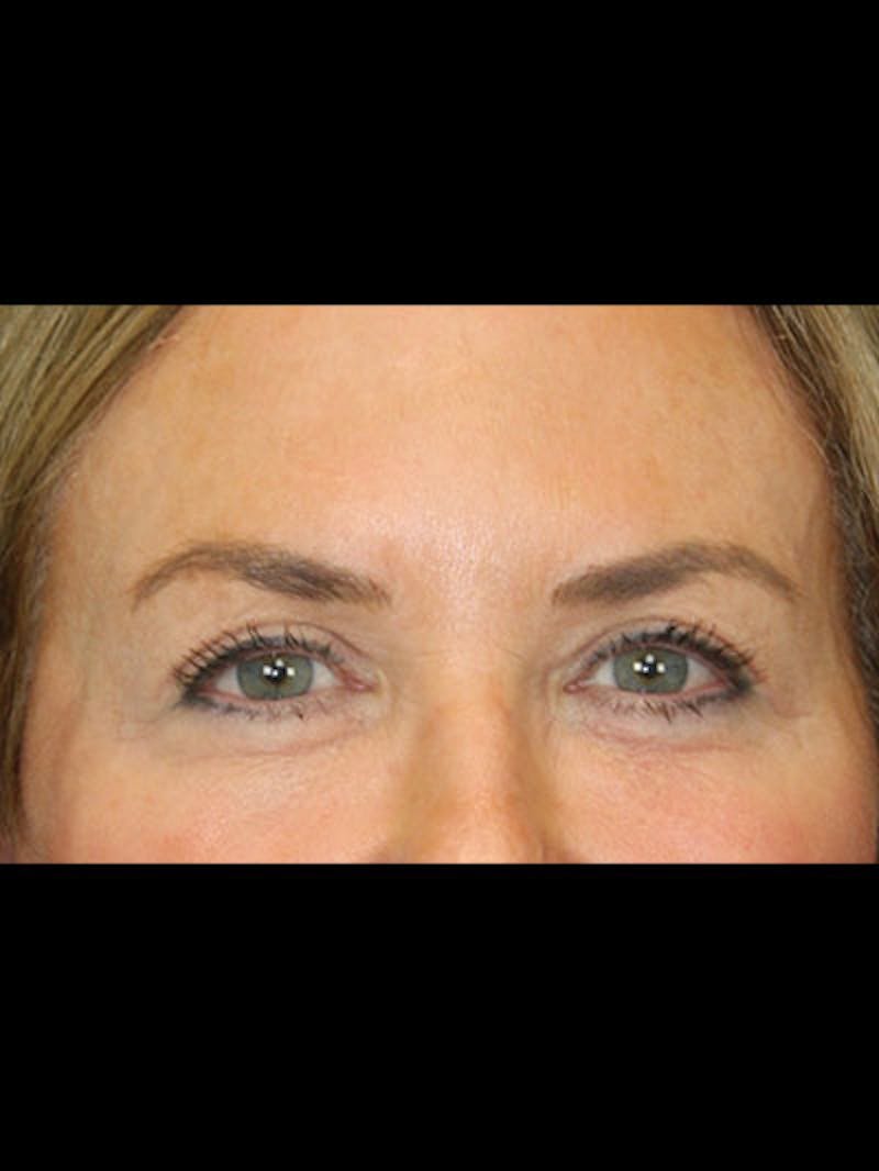 Brow Lift Before & After Gallery - Patient 143521869 - Image 4
