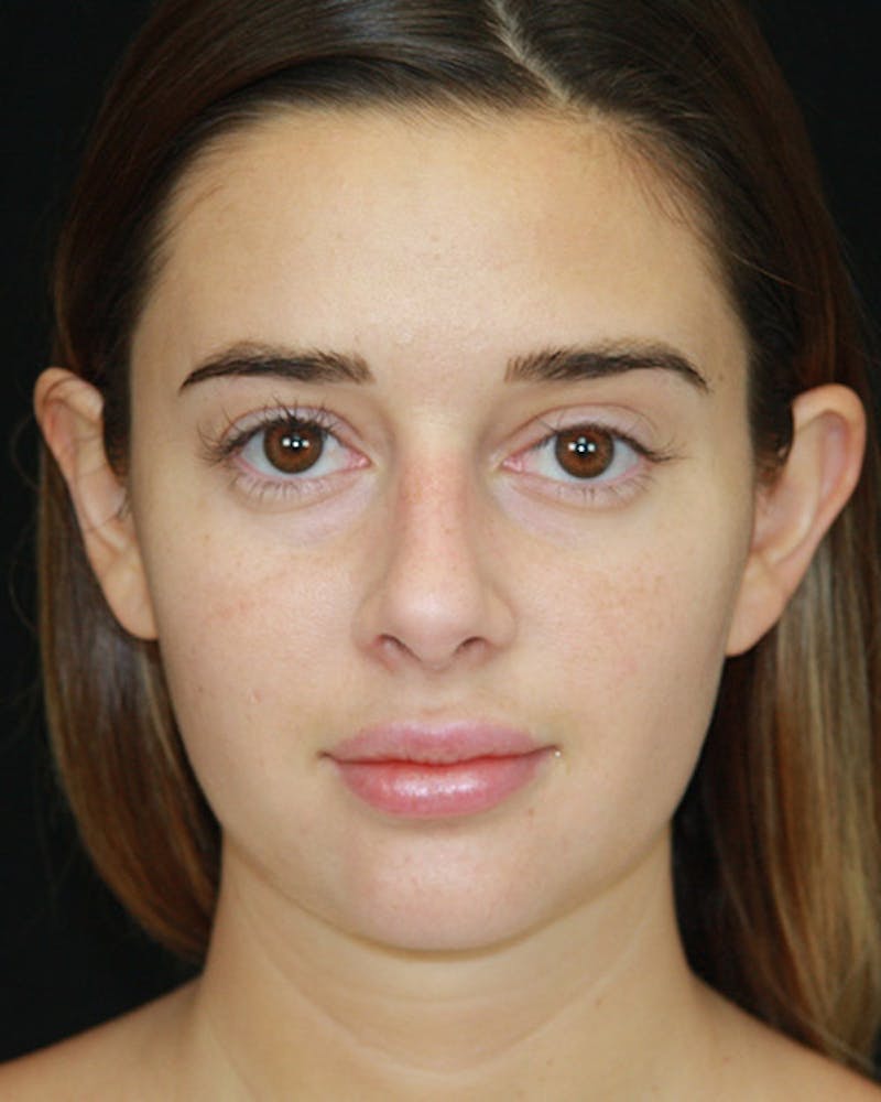 Rhinoplasty Before & After Gallery - Patient 143521876 - Image 1