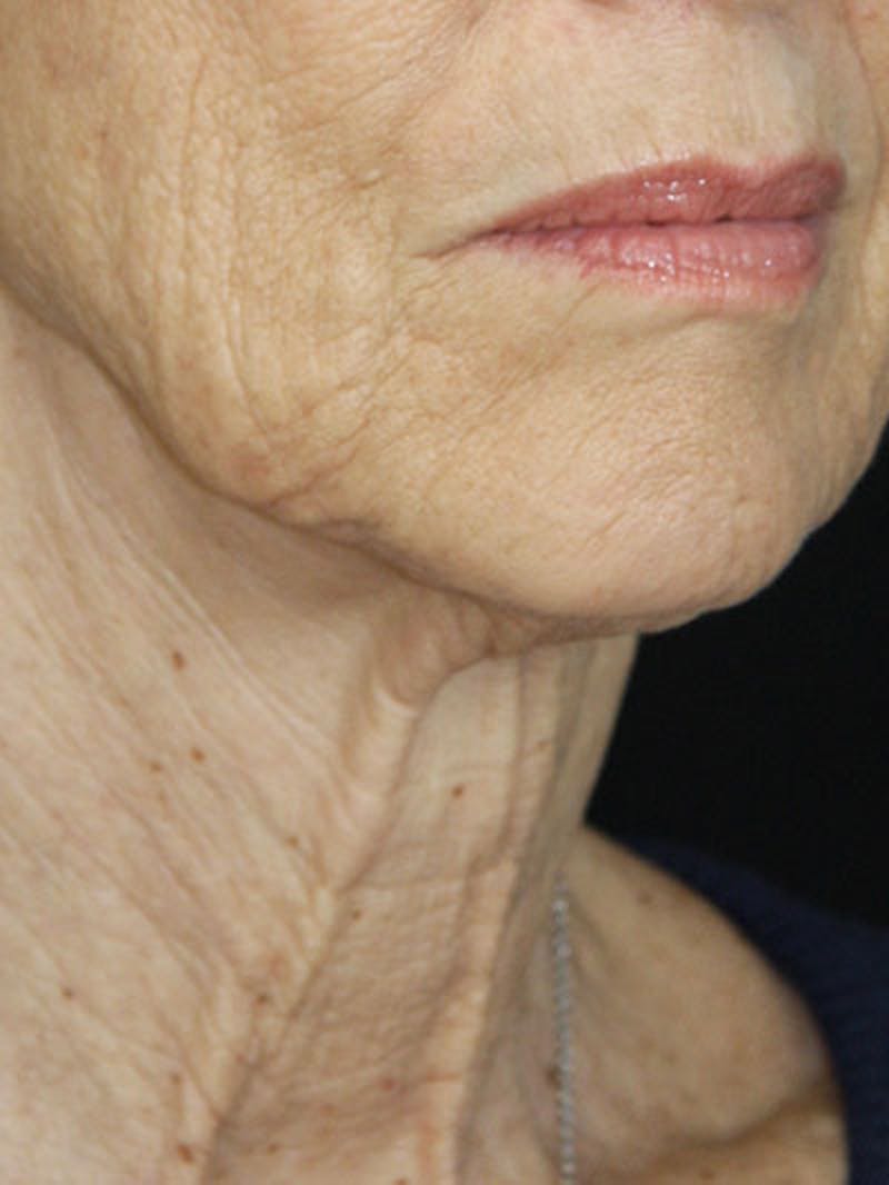 Facelift & Neck Lift Before & After Gallery - Patient 177555042 - Image 3
