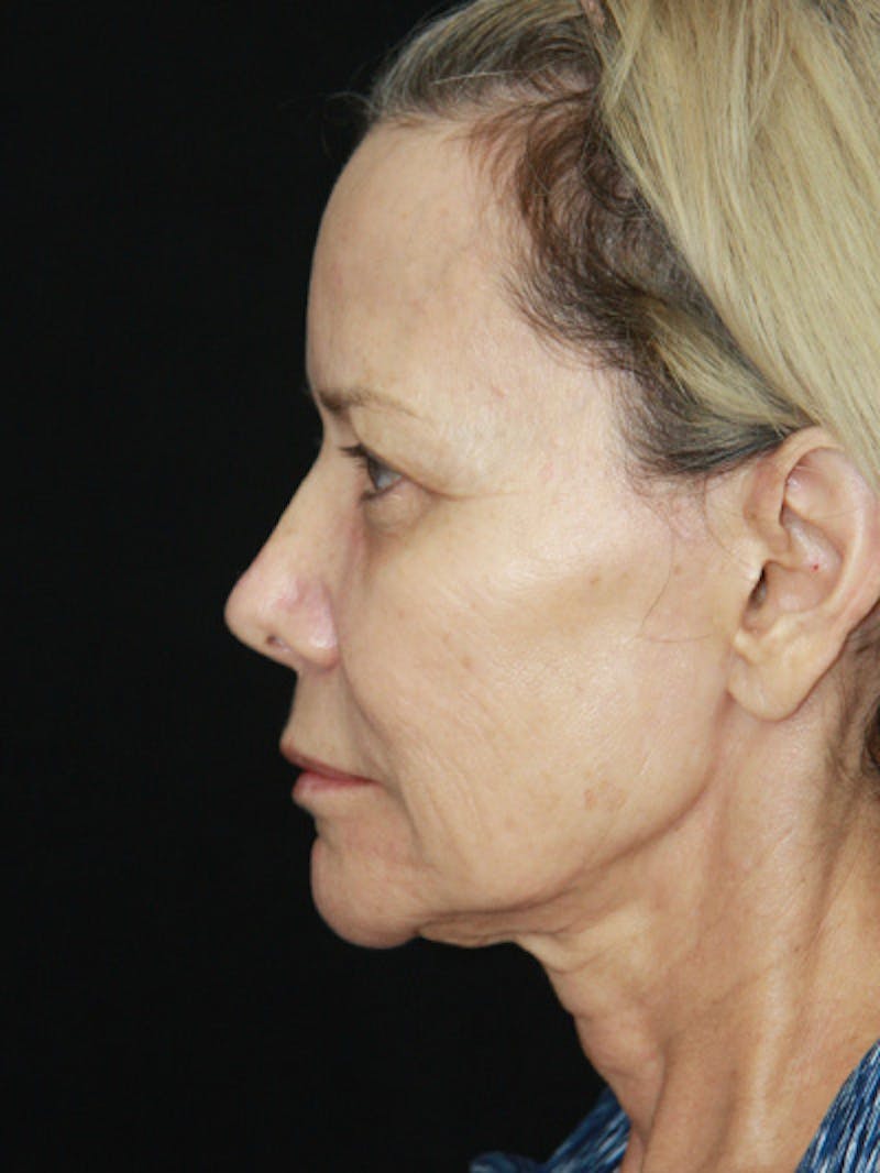 Facelift & Neck Lift Before & After Gallery - Patient 143521872 - Image 9