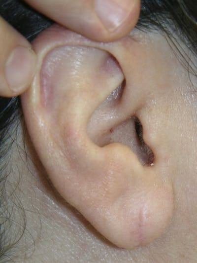 Ear Lobe Repair Before & After Gallery - Patient 143521871 - Image 2