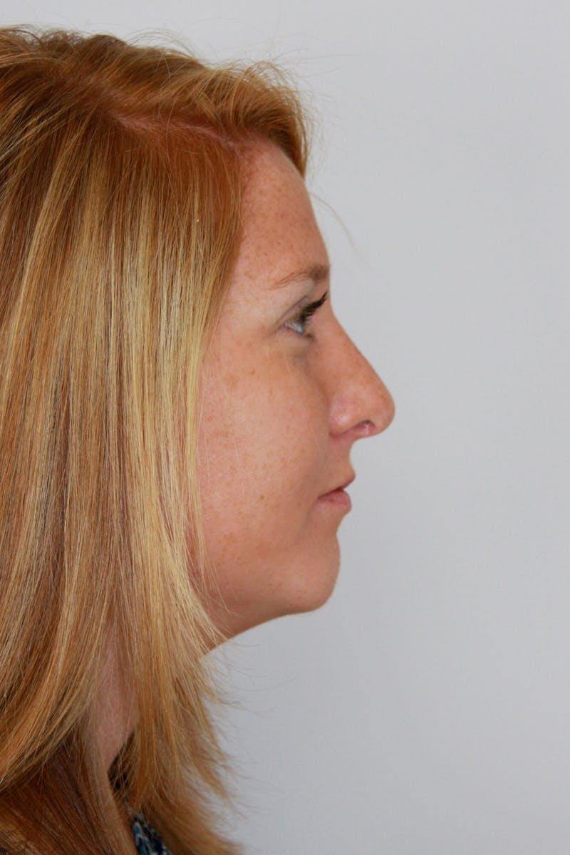 Chin Augmentation Before & After Gallery - Patient 143521889 - Image 2