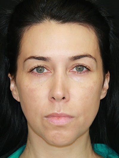 Brow Lift Before & After Gallery - Patient 143521874 - Image 1
