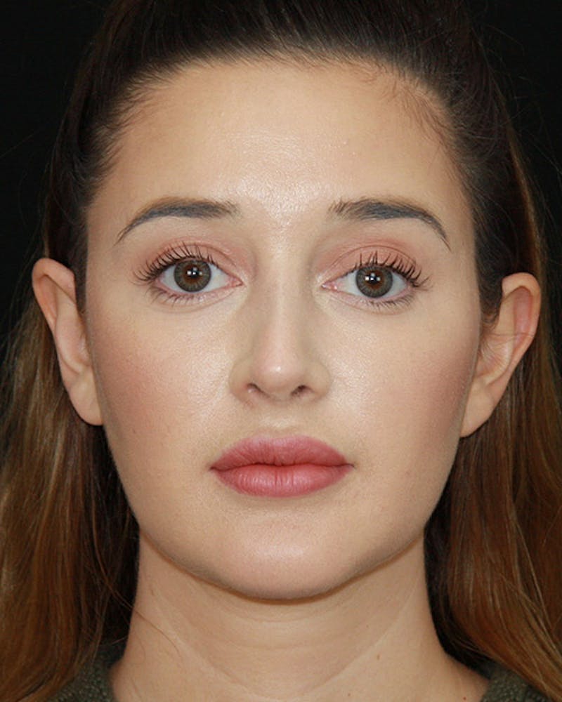 Rhinoplasty Before & After Gallery - Patient 143521876 - Image 2